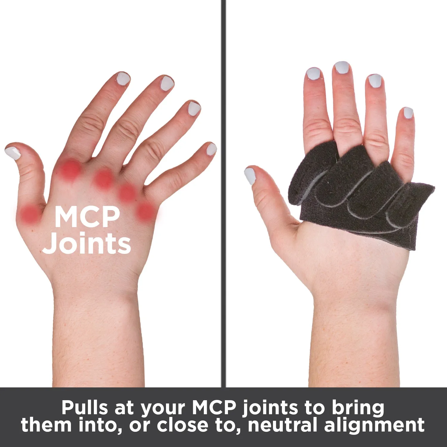 Ulnar Deviation / Drift Hand Splint for Arthritis & MCP Knuckle Joint Support